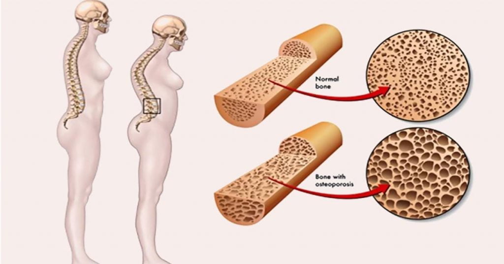 Loãng xương: nguyên nhân, triệu chứng, biện pháp phòng ngừa, điều trị 