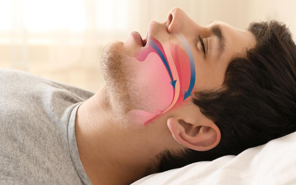 10 câu hỏi cần biết về chứng ngưng thở khi ngủ