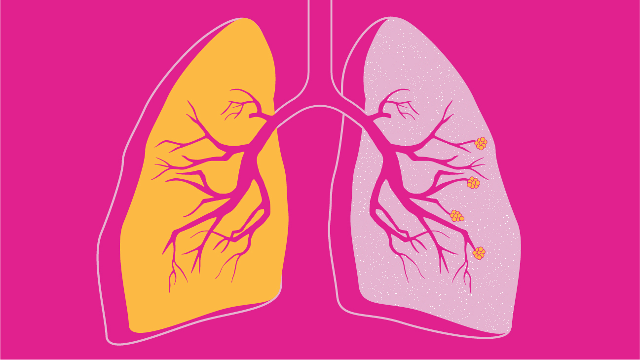 9 câu hỏi cần phải biết về COPD