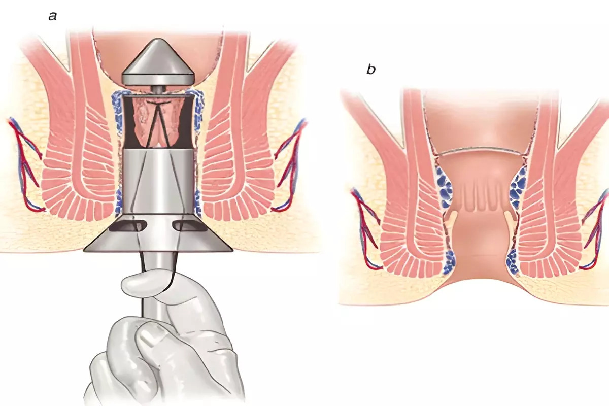 Phương pháp cắt trĩ Longo