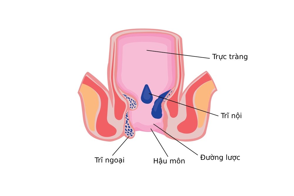 phân loại bệnh trĩ