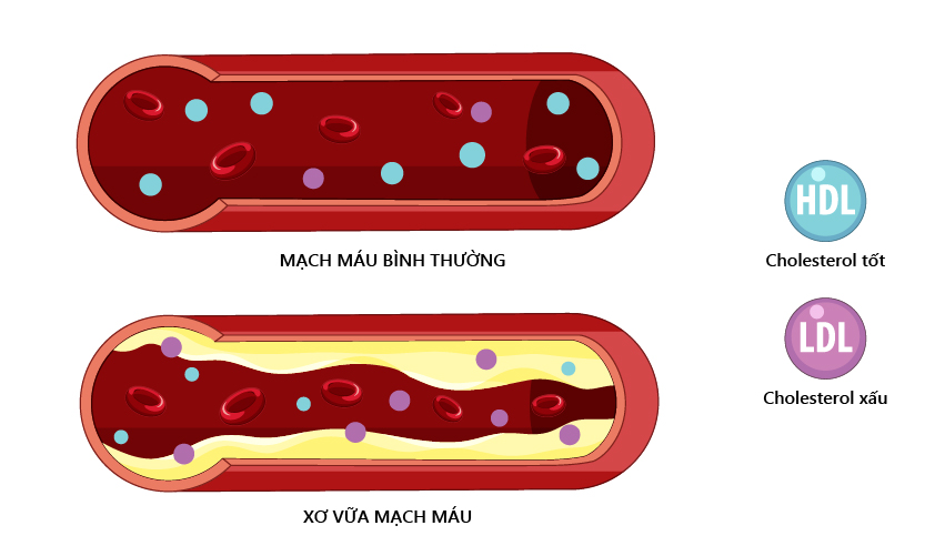 xơ vữa mạch máu