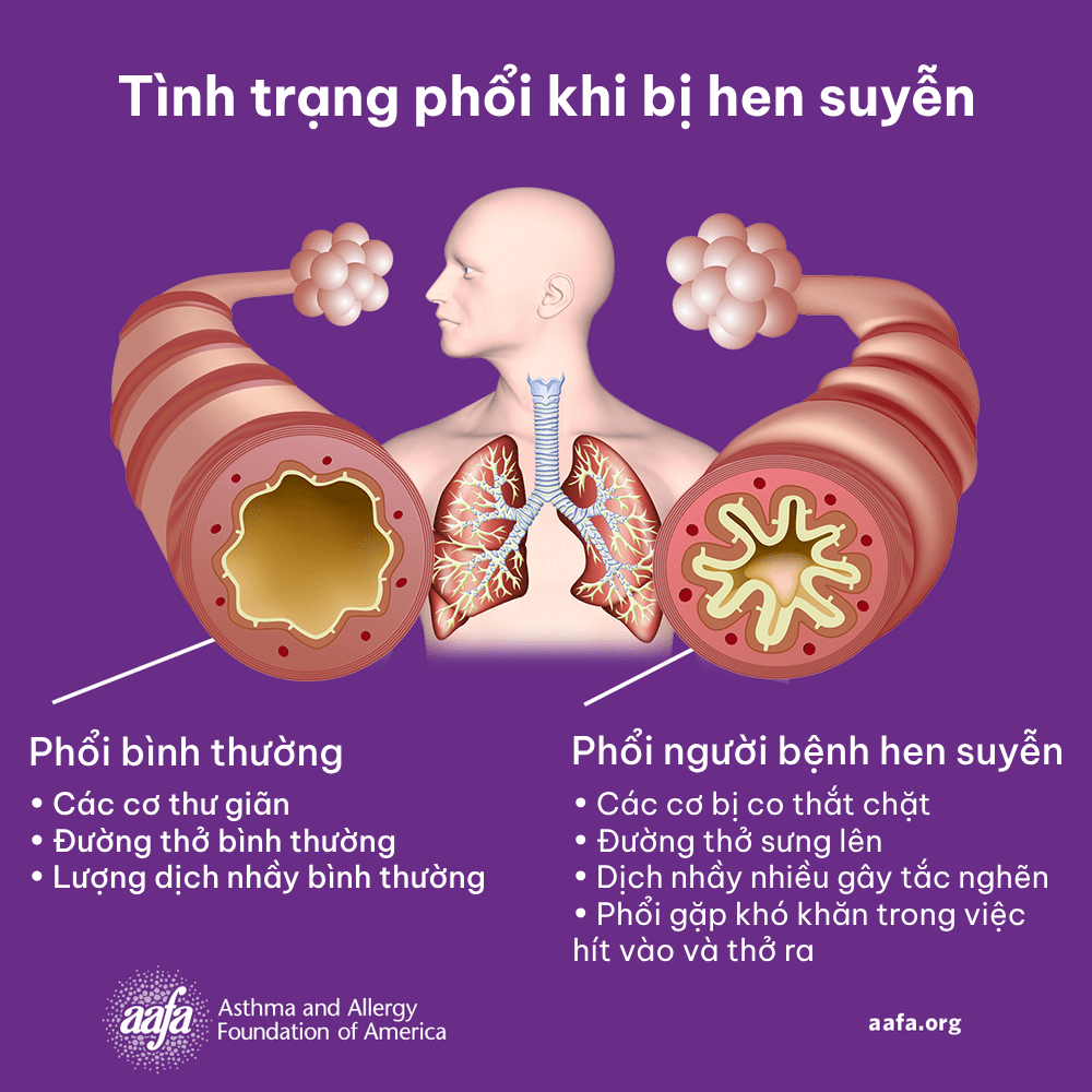 tình trạng phổi bệnh hen suyễn và các triệu chứng