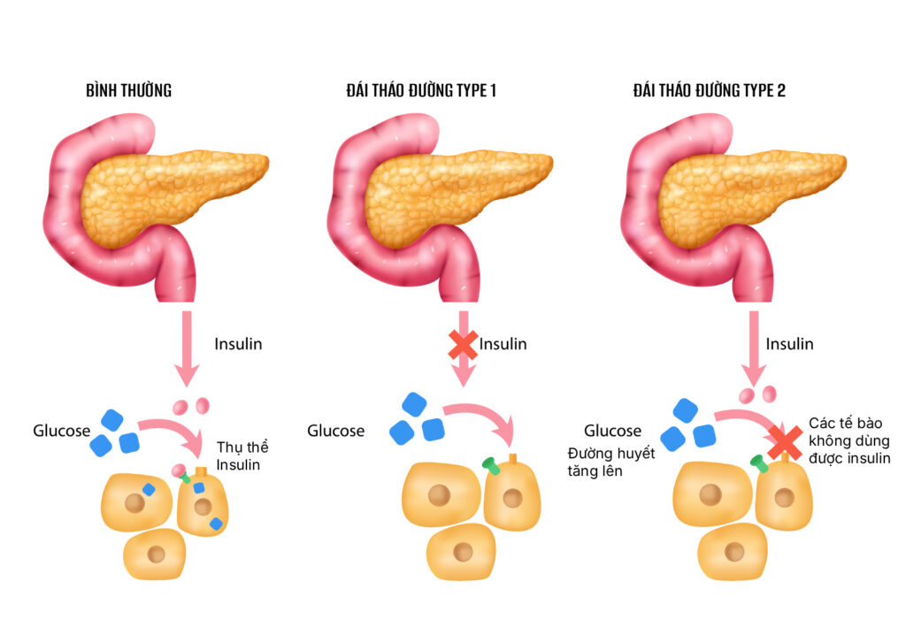 nguyên nhân bệnh đái tháo đường là gì
